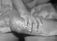 Monkeypox is not shingles and there is no evidence that the Monkeypox outbreak has anything to do with the COVID-19 vaccines